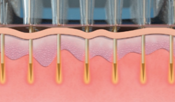 従来の垂直ニードル