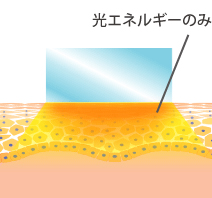 従来の光治療